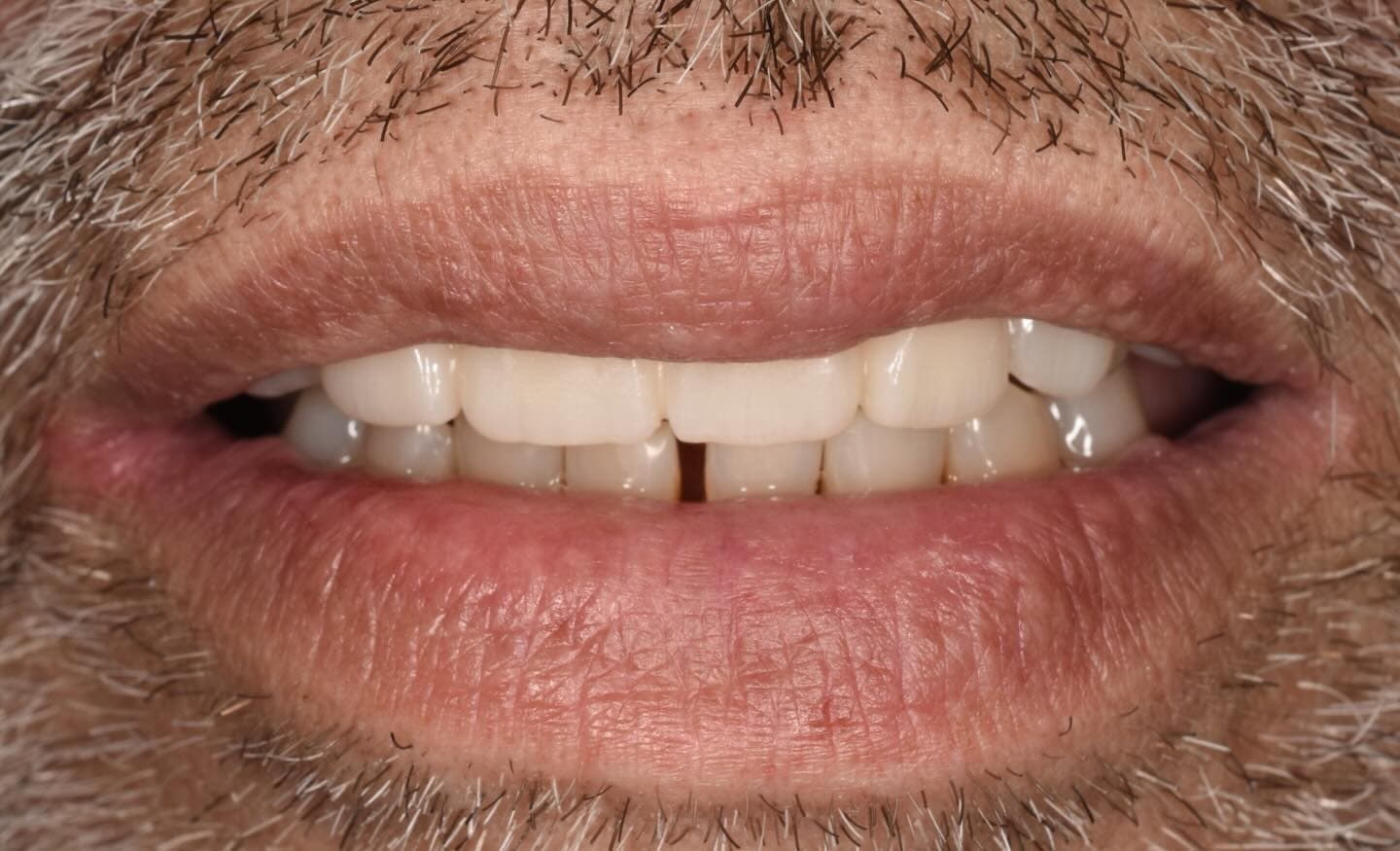 След лечение – д-р Йорданова Специалист по протетична дентална медицина Варна