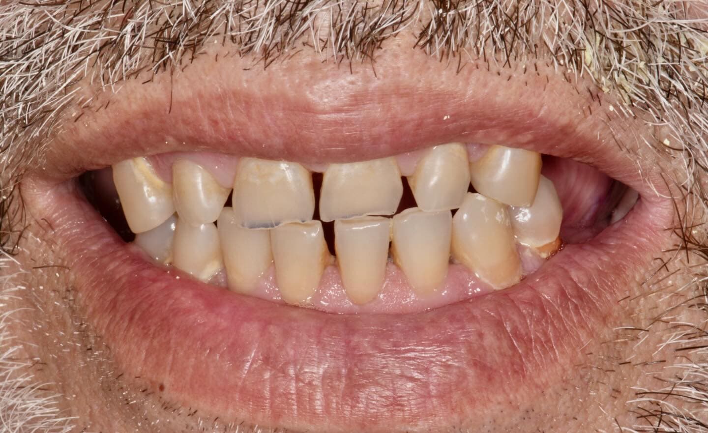 Преди лечение – д-р Йорданова Специалист по протетична дентална медицина Варна